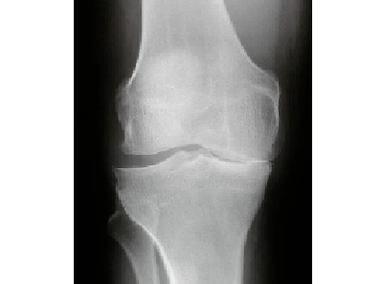 Diagnóstico da artrose da articulación do xeonllo