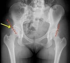 Métodos para o tratamento da artrosis da articulación da cadeira