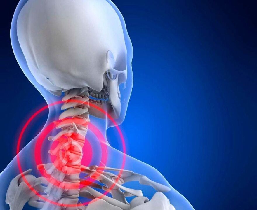 Dor no pescozo con osteocondrose cervical