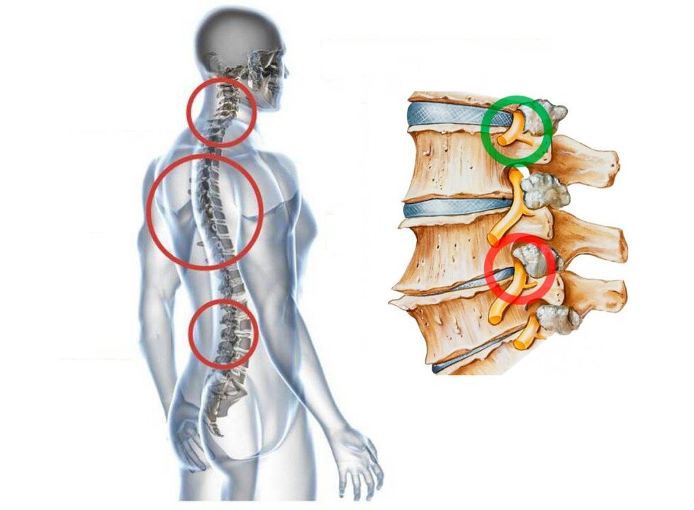 Que parece a osteocondrose cervical