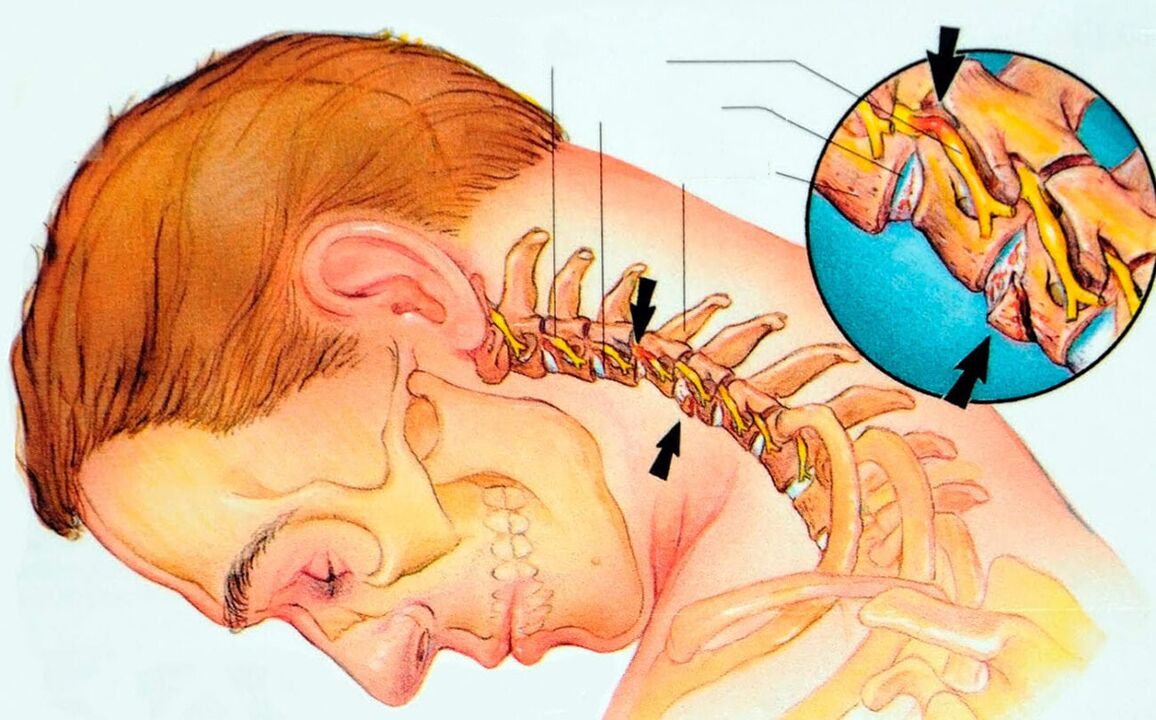 Que é a osteocondrose cervical
