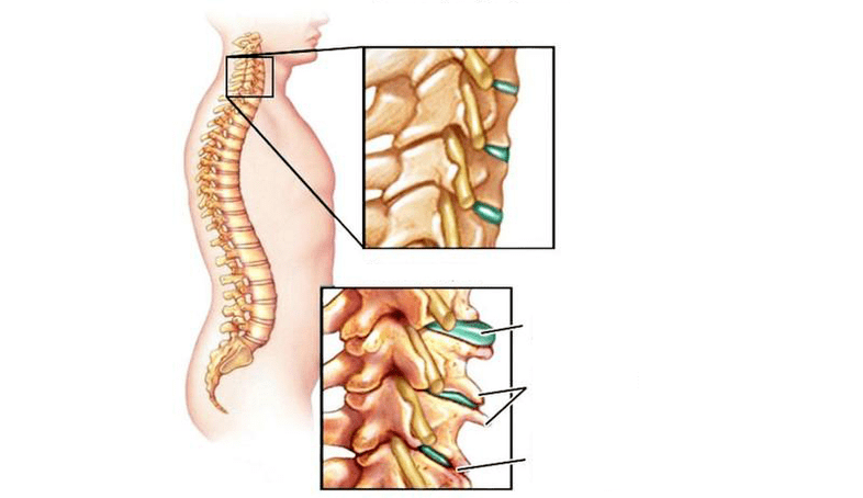 Síndromes de osteocondrosis