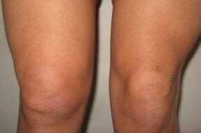 Inflamación na articulación do xeonllo con artrite e artrose