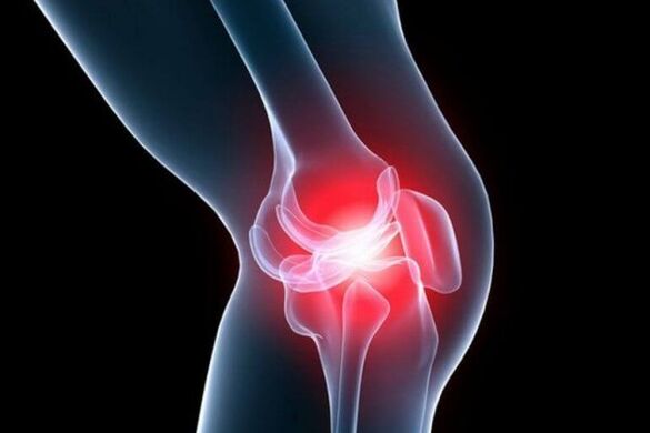 Osteoartrite da articulación do xeonllo