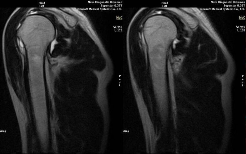 Osteoartrite da articulación do ombreiro na radiografía