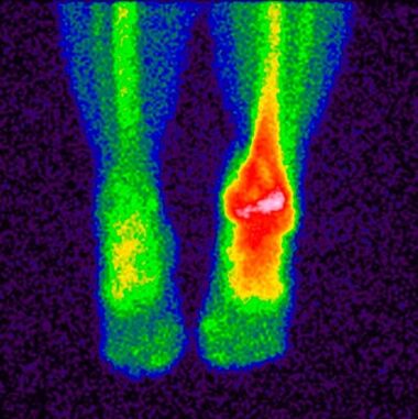 O método de diagnóstico diferencial da artrose cruzada é a gammagrafía